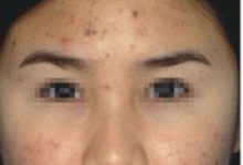 怎么去除痘印最有效的方法 - 识趣